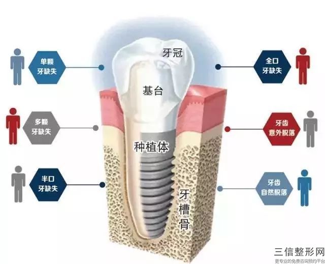 12顆全瓷牙要多少錢，你知道嗎？