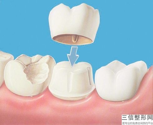 拔智齒的價錢是5百到1千元一顆嗎