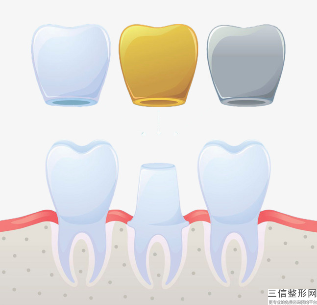 杭州全瓷牙一般多少錢，今天就通過這篇文章