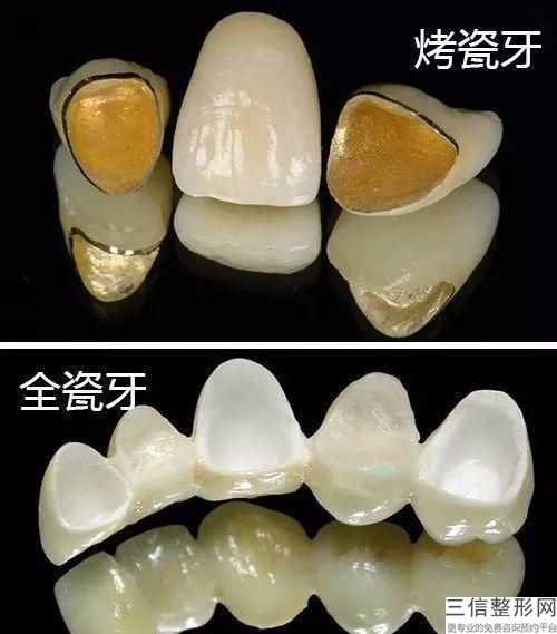 種植全瓷牙一般多少錢各種原因導致牙齒缺失的大有人在