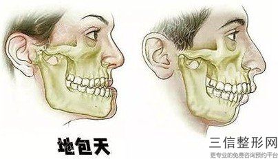 整形瘦臉多少錢微整形不知從何時起就變的火爆起來