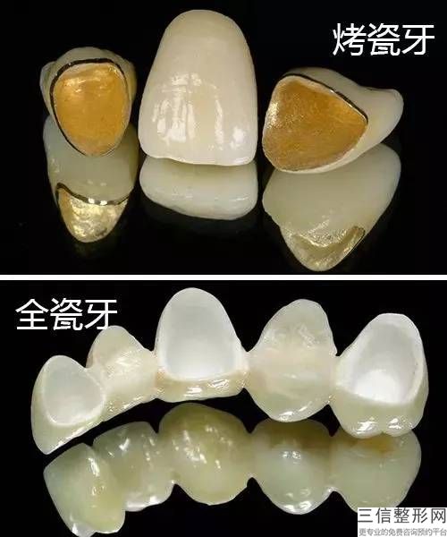 牙齦外露修復多少錢