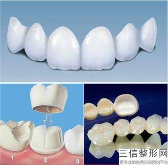 全瓷牙的材料和價格影響因素有哪些？鑄瓷