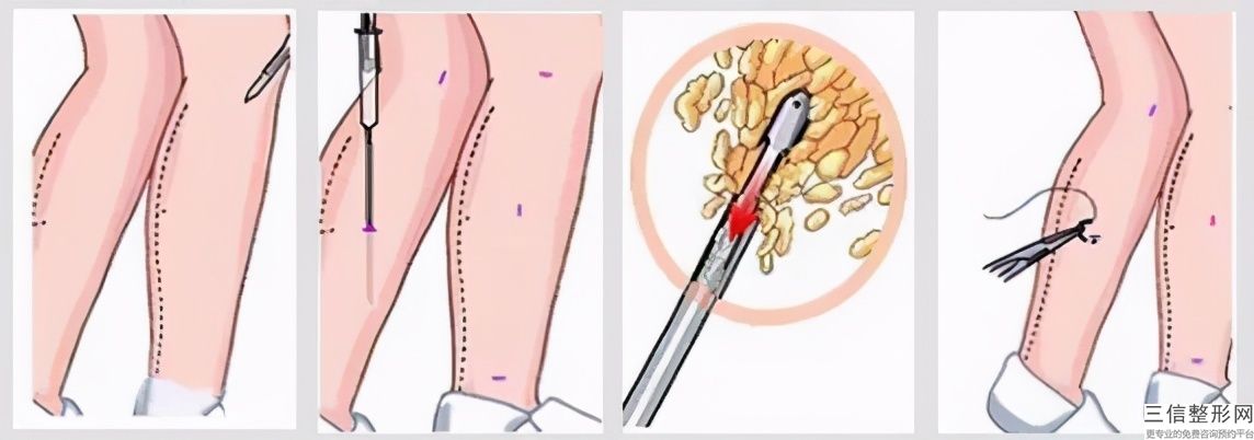 抽脂瘦大腿一般多少錢(抽脂瘦大腿大概價格參考表)