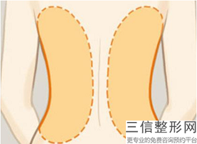 自體脂肪豐下巴一般多少錢(自體脂肪豐下巴大概價格參考表)