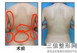 電子吸脂瘦大腿什么時候生效？你能走多長時間？