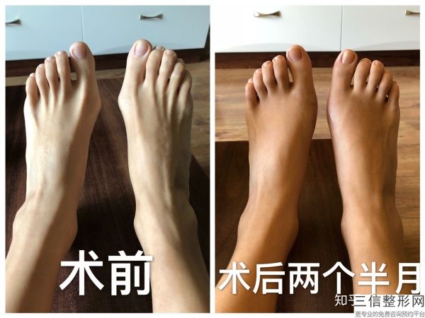 只有長(zhǎng)腿有什么用？隆臀的脂肪自體移植多少錢？