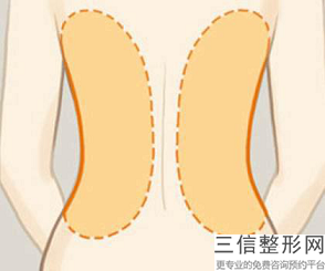 做大腿側(cè)吸會(huì)恢復(fù)嗎？大腿抽脂后一般不會(huì)明顯的疼痛