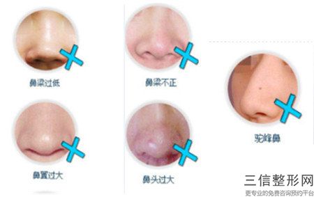 在合肥形成人工酒窩的費用是多少？整形的恢復時間