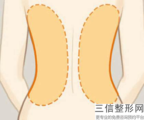 鄭州激光溶脂的費用是多少呢？術后要做好護理工作