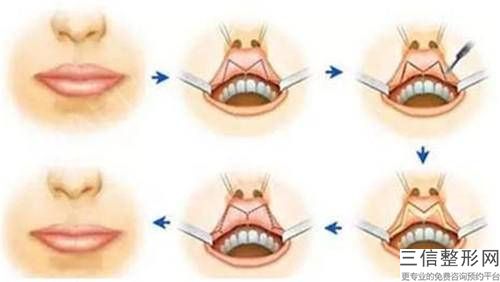 鄭州嘴唇變薄多少錢？讓我們的專家為您詳細(xì)介紹