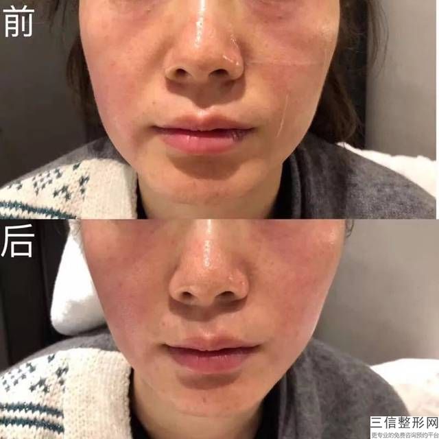 安達的光子美白牙齒會恢復嗎？安達牙齒美白會怎么樣？