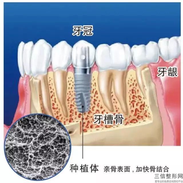 長沙門牙做瓷牙要多少錢？瓷器修復的因素