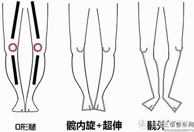 上海抽脂瘦腿多少錢？吸脂瘦腿后不宜吃辛辣食物