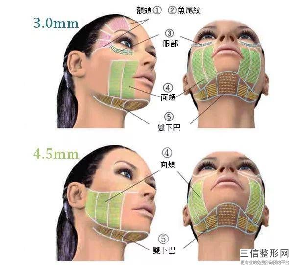 小面骨磨削手術會引起什么副作用呢？威望專家怎么說