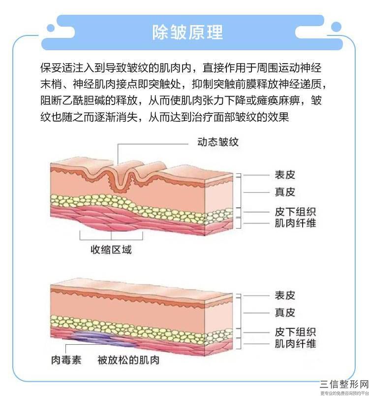 自體脂肪除皺手術有哪些優勢？注射脂肪來去除皺紋