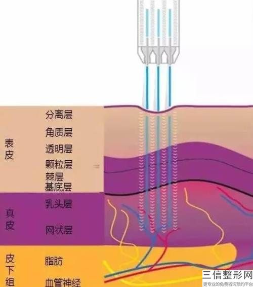 合肥小切口除皺除皺修復多少錢？讓我們聽(圖)