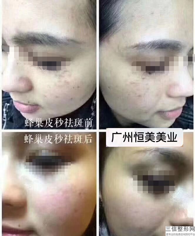 深圳美萊激光脫毛多少錢？價格是多少？怎么樣