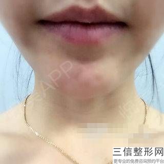 為什么唇部外翻矯正效果這么好呢？讓我們來看看