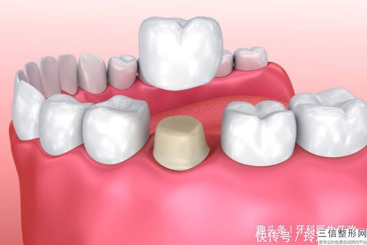 合金烤瓷牙多少錢,普通烤瓷牙大概要多少錢