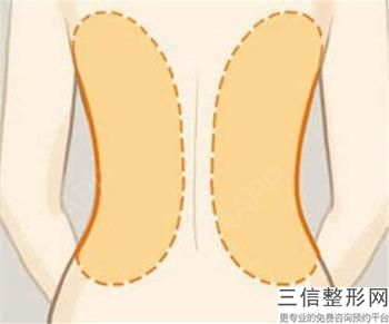 雙下巴吸脂方法有幾種