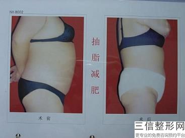 做大腿激光輔助抽脂打麻藥嗎讓你成為冰爽美人