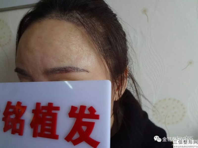 因為遺傳導致的脫發（alopecia）應該怎么緩解