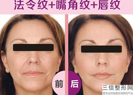 注射Juvederm豐臥蠶的效果大致可以維持多久