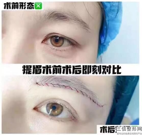 熊貓眼去除整形手術怎樣