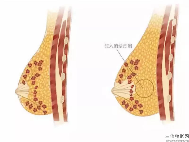 做韓式假體隆胸手術(shù)費用為什么不一樣