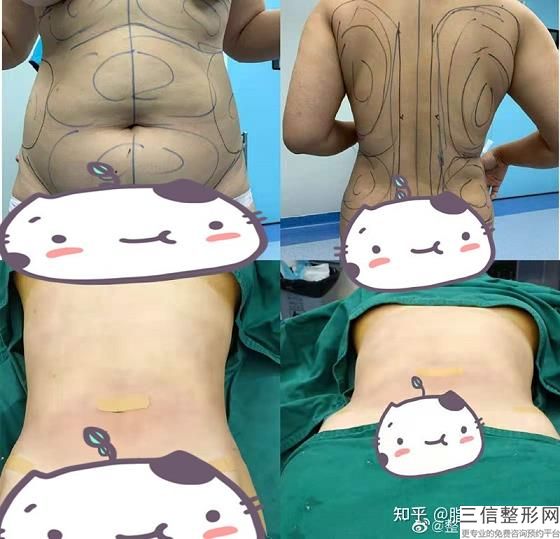 沈陽「今日頭條」乳房吸脂手術,記者爆料