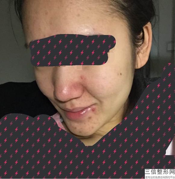 鼻小柱怎么抬高，鼻小柱抬高是延長嗎