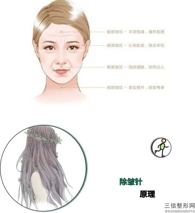 抬頭紋除皺針多久見效，抬頭紋除皺針的危害和副作用