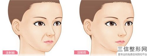 株洲botox除皺針手術一共要花費多少錢