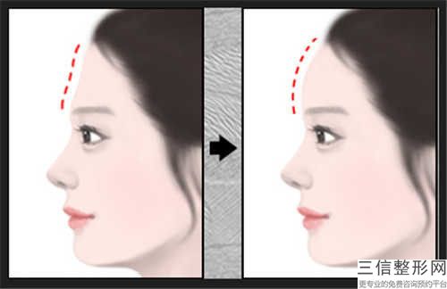 鹽城市韓國額頭整形價格(費用)清單(7月-1月均價為：11366元)