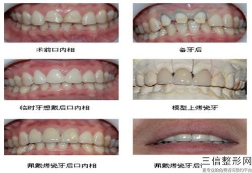 淮安市茶漬牙美白價格表鑒賞(8月-2月均價為：317元)