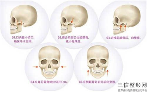 開封市上頜后縮矯正醫生口碑排行榜十強驚喜上線-開封市李月整形醫生