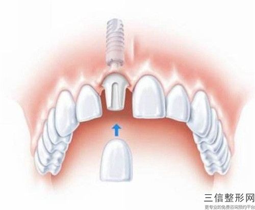 長春做冷光牙齒美容手術的費用是多少與哪些因素有關