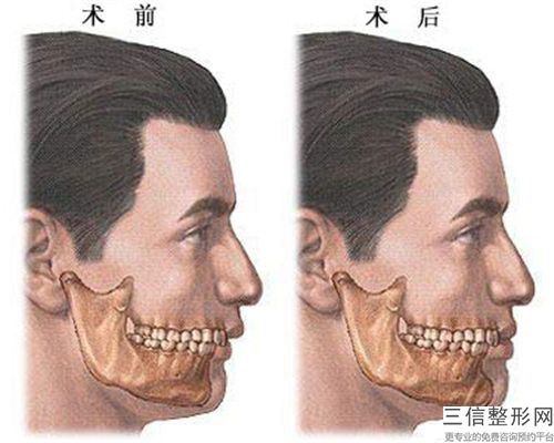 梧州市微創(chuàng)隆下巴手術醫(yī)院口碑榜前10強知名盤點(梧州市微創(chuàng)隆下巴手術整形醫(yī)院)