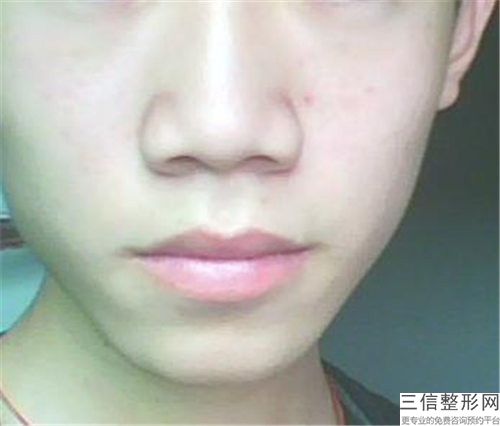 浙江省重度鼻翼缺損修復醫生TOP10排名大眾推薦-彭繼忠醫生滿意度賊高