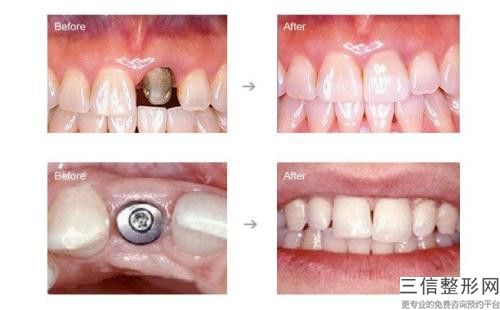 宿州市種植牙修復牙縫寬大手術價格在線一覽-宿州市種植牙修復牙縫寬大價格