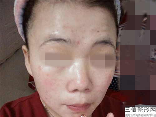 激光美容去除痘印的大概費用需要多少