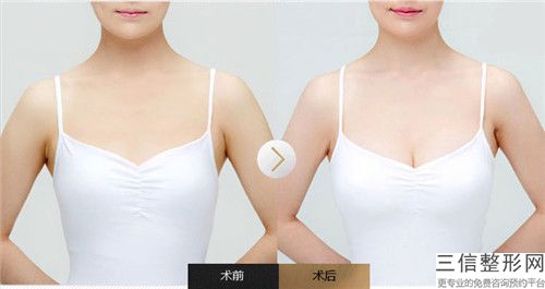 承德哺乳豐胸手術有沒有危險