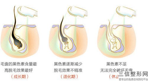 朝陽市整容醫院絡腮胡脫毛術哪家較好-絡腮胡脫毛術價格如何確定呢