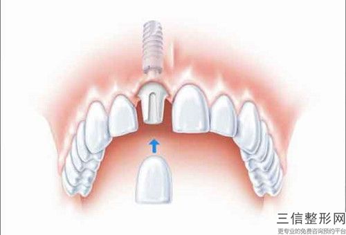 泉州牙齒牙根外露術究竟需要多少費用