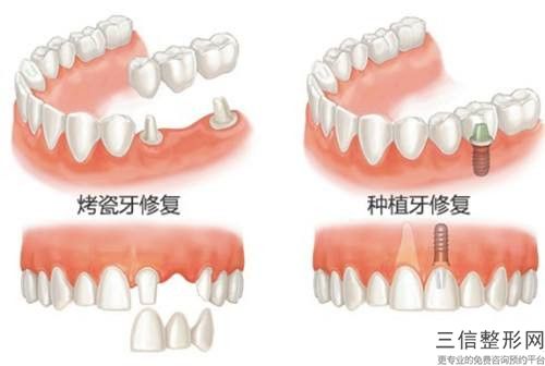 濮陽前牙固定橋增力橋架費(fèi)用大概多少錢呢