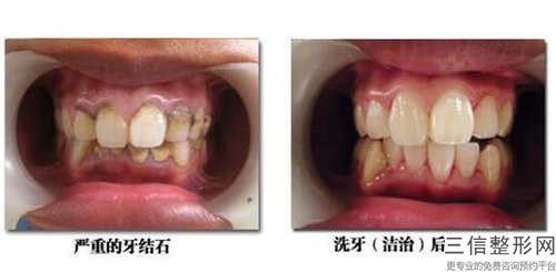 牡丹江格萊美全瓷牙費用價格多少