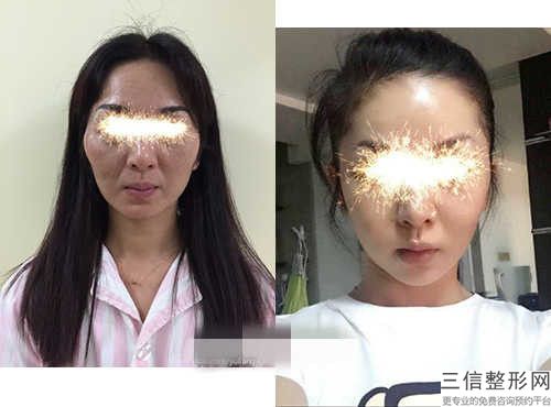 國內整形醫院下頜骨不平滑多少錢：下頜骨不平滑醫院前50名權威上線