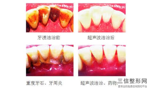 嘉興下牙內側露牙根術大約多少錢