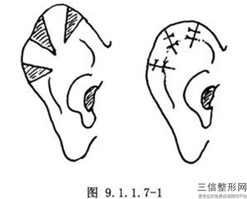 遼陽(yáng)讓耳朵變成招風(fēng)耳整形美容價(jià)格是多少